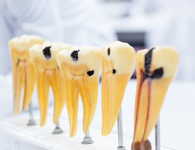 五反田の歯医者、ツツミ歯科クリニックのむし歯治療