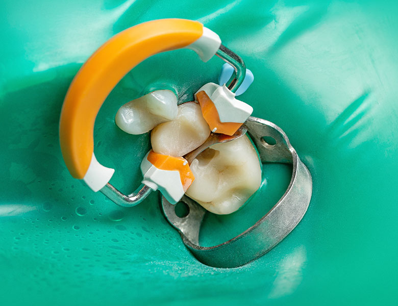 五反田の歯医者、ツツミ歯科クリニックの根管治療