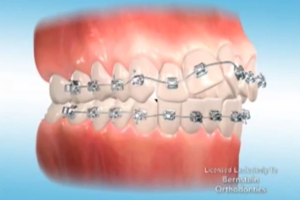 五反田の歯医者、ツツミ歯科クリニックの大人の矯正歯科
