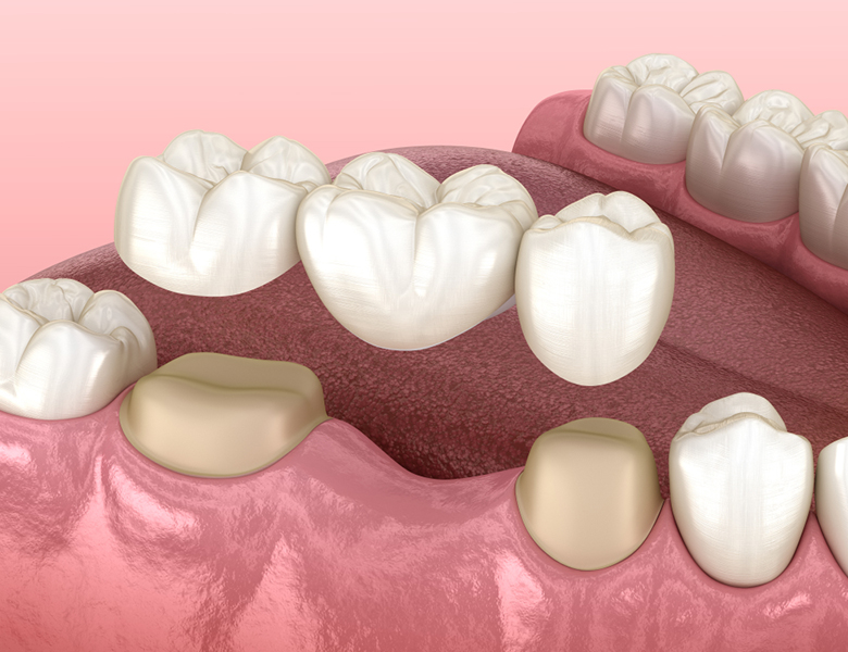 五反田の歯医者、ツツミ歯科クリニックのインプラント治療
