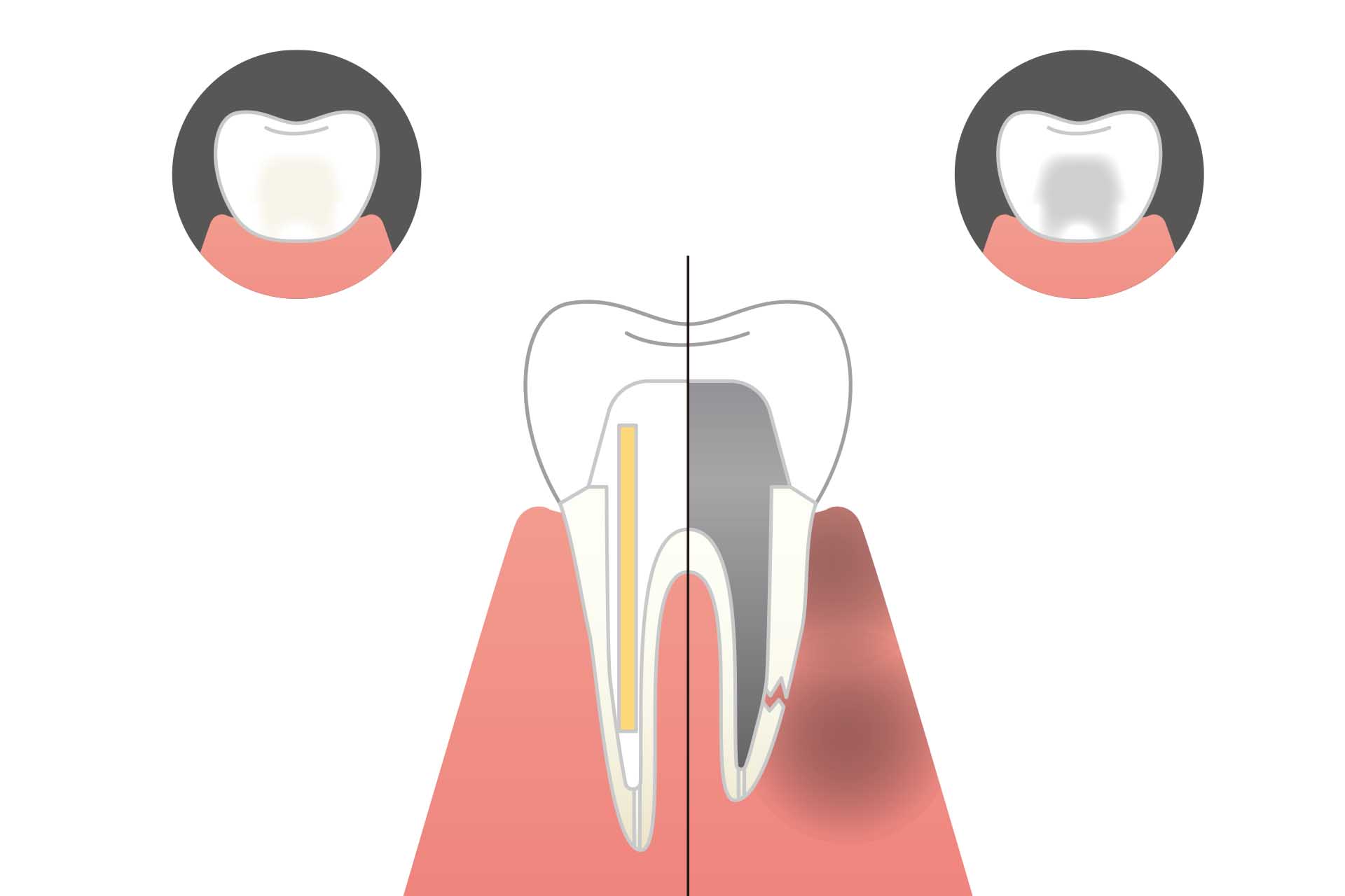 五反田の歯医者、ツツミ歯科クリニックの根管治療