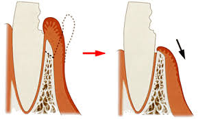 五反田の歯医者、ツツミ歯科クリニックのむし歯治療
