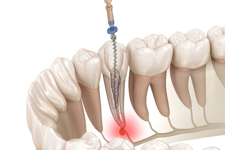 五反田の歯医者、ツツミ歯科クリニックの根管治療