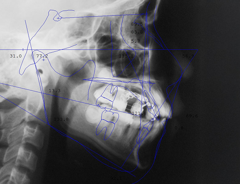 五反田の歯医者、ツツミ歯科クリニックのセファログラム
