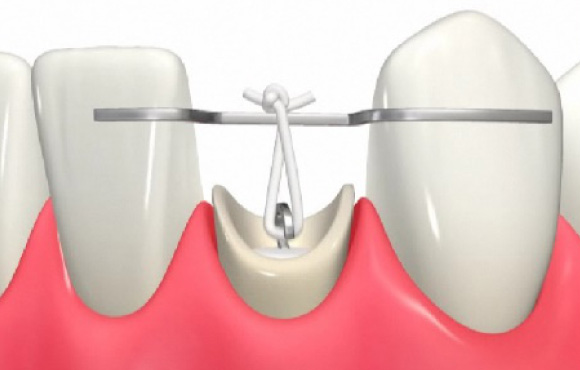 五反田の歯医者、ツツミ歯科クリニックのむし歯治療