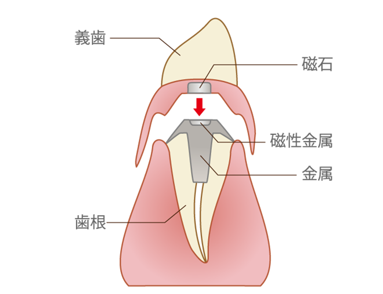 五反田の歯医者、ツツミ歯科クリニックの入れ歯治療