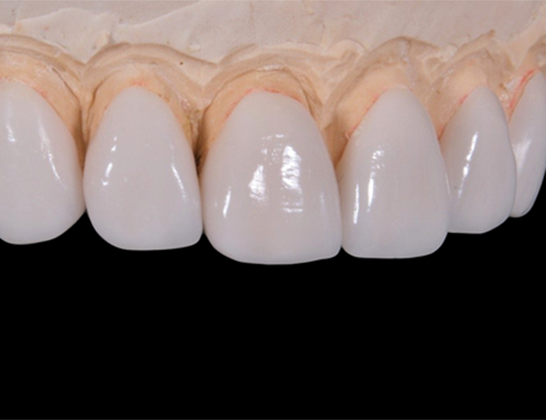 五反田の歯医者、ツツミ歯科クリニックの審美修復