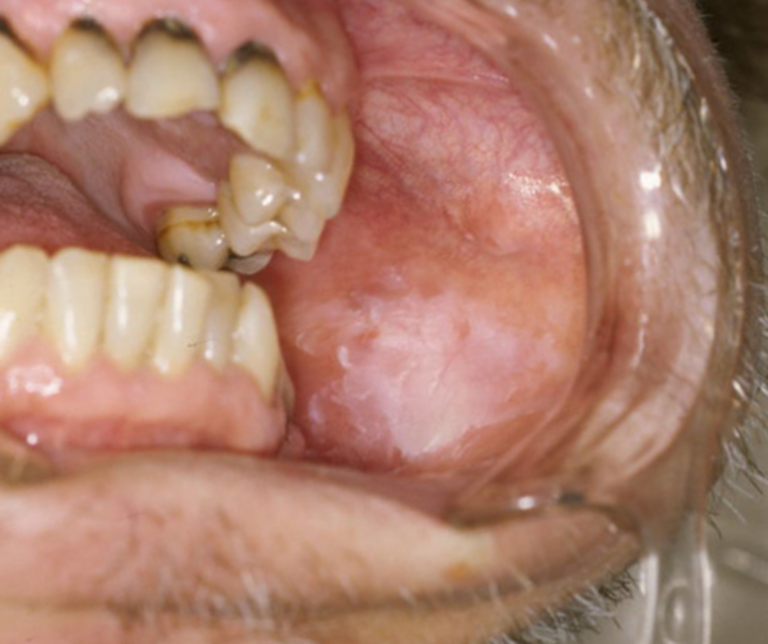 五反田の歯医者、ツツミ歯科クリニックのお口の中のデキモノ