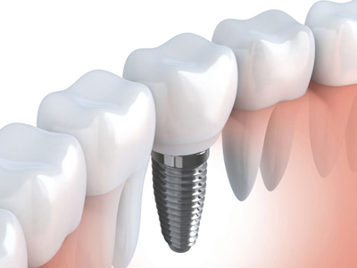 五反田の歯医者、ツツミ歯科クリニックのインプラント治療