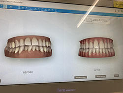 五反田の歯医者、ツツミ歯科クリニックのインビザライン矯正治療