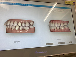 五反田の歯医者、ツツミ歯科クリニックのインビザライン矯正治療