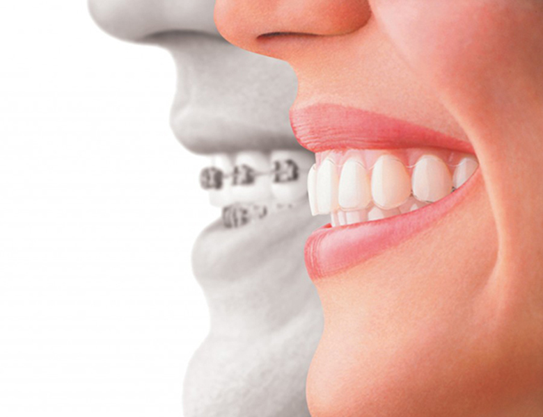 五反田の歯医者、ツツミ歯科クリニックのインビザライン矯正治療
