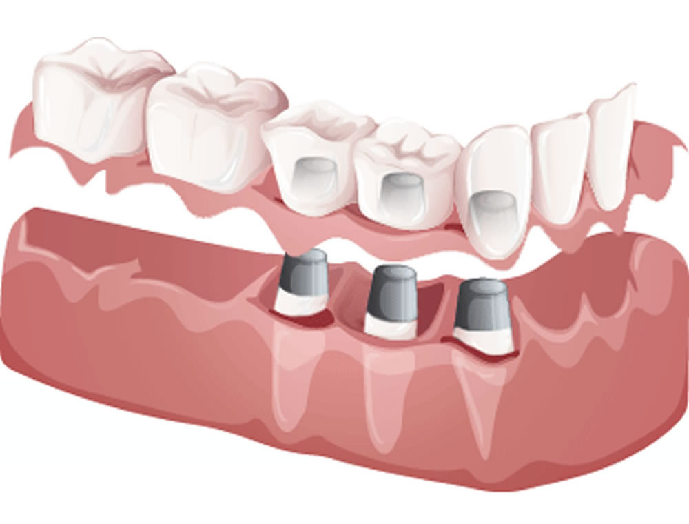 五反田の歯医者、ツツミ歯科クリニックの入れ歯治療