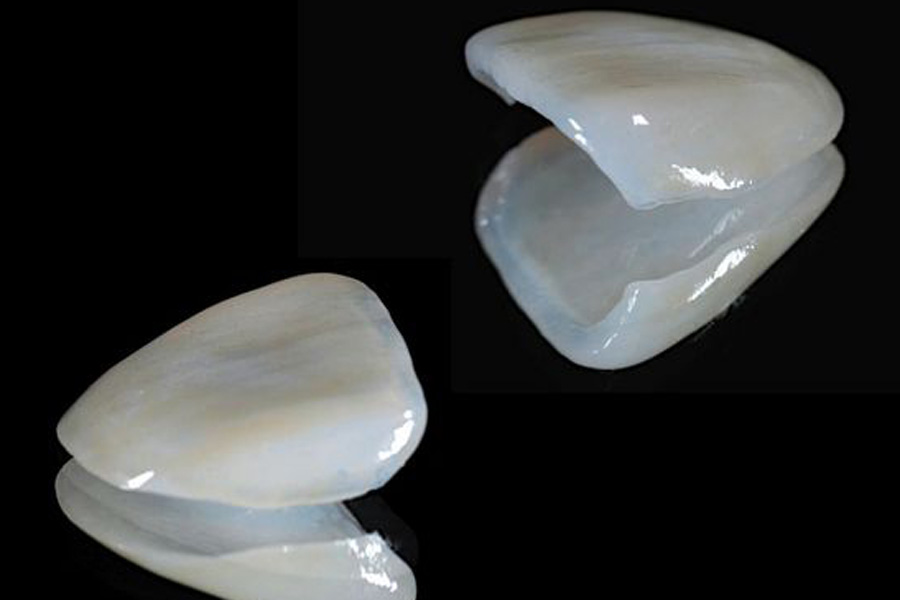 五反田の歯医者、ツツミ歯科クリニックの審美修復