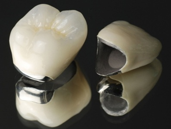 五反田の歯医者、ツツミ歯科クリニックの審美修復