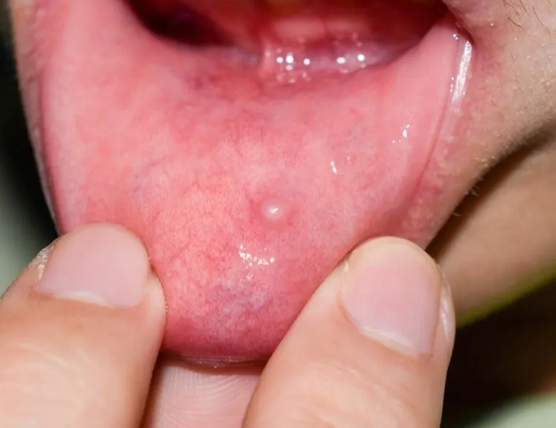 五反田の歯医者、ツツミ歯科クリニックのお口の中のデキモノ