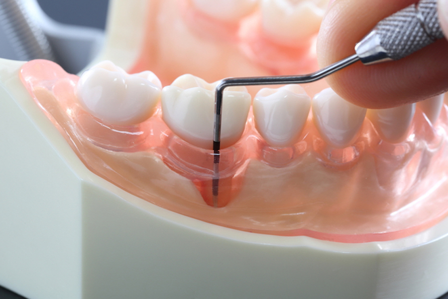 五反田の歯医者、ツツミ歯科クリニックの歯周病治療