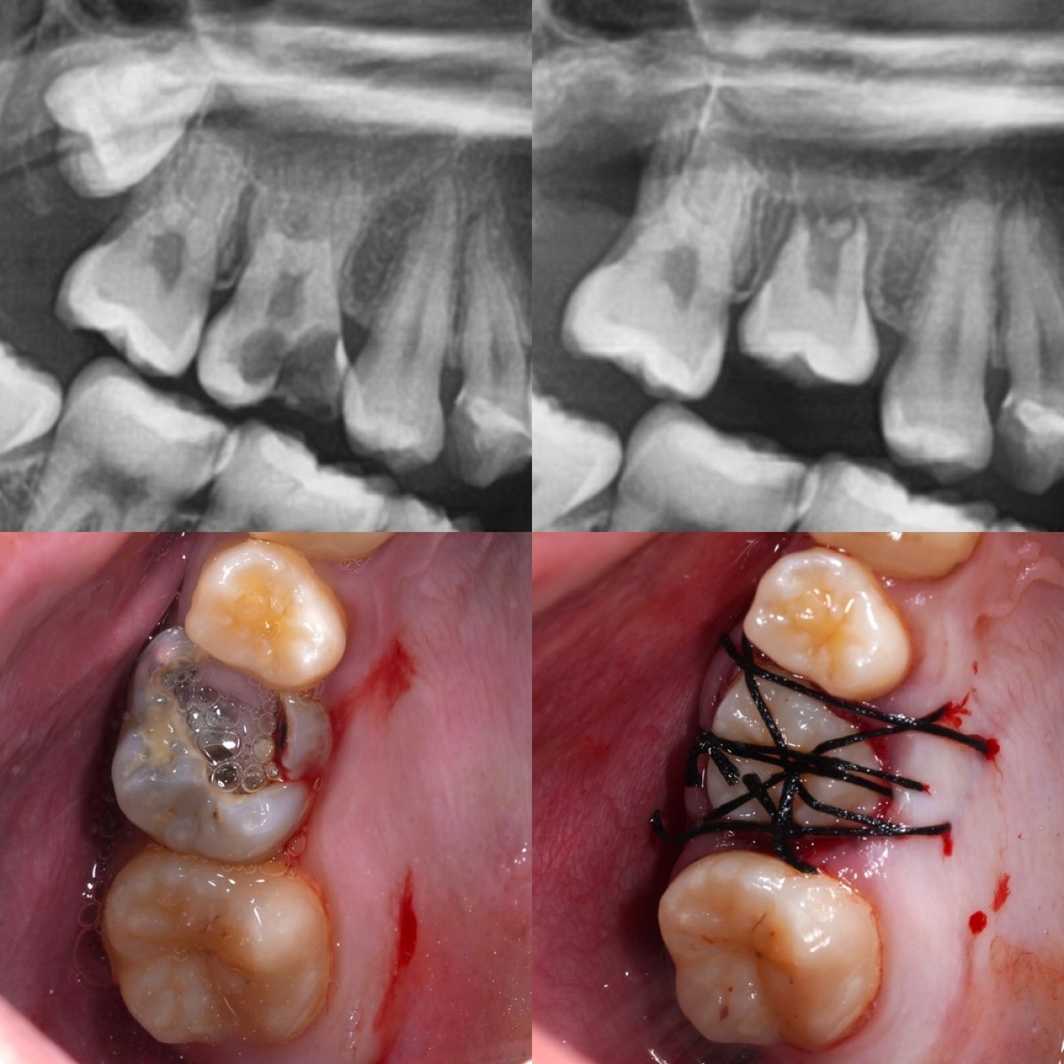 五反田の歯医者、ツツミ歯科クリニックの自家歯牙移植
